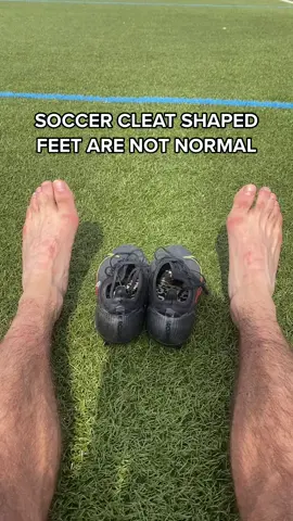 For years I crammed my feet into tight ass soccer cleats. Only to realize I destroyed my foot function. #feet #bunion #Soccer #football #prehab #rehab