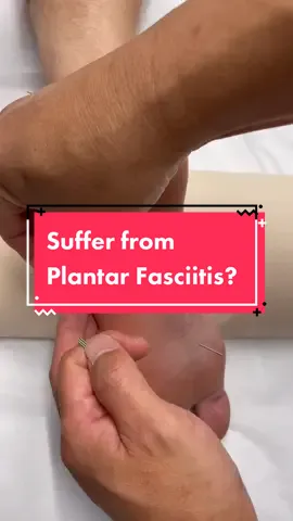 Reply to @sabwalls Plantar fasciitis & #acupuncture! #GetAdjustedNow #footpainrelief #footpaintreatment #plantarfasciitis #nycacupuncture #nycchiro