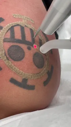 So satisfying! #satisfying #asmr #lasertattooremoval #laser #tattoolover  #tattooremoval #dmv #virginia #fyp #foryou