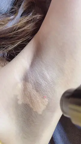 Bắn trẻ hóa nách🥰🥰