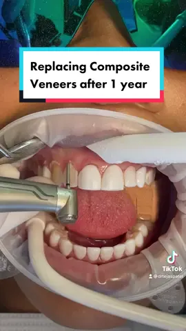 Replacing composite veneers after 1 year. #colombiaveneers #veneers #compositeveneers #dentist #veneersjourney #austin #texas #cosmetics