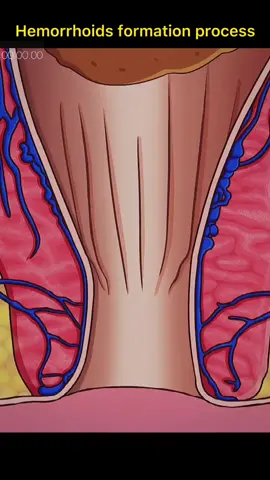 #hemorrhoids #formation #process #foryou #fypシ