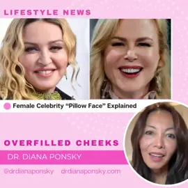 PILLOW FACE😳❌💉🤦🏻‍♀️ #cheekfiller #cheekfillers #plasticsurgery #cosmeticsurgery #drdianaponsky #dermalfiller #dermalfillers #allergan #galderma #celebrity #facialplasticsurgeon