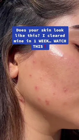 The PRODUCTS that changed my skin😍 #foryoupage #foryou #StartUpShowUp #trending #skin #skincare #acne #acneskin #clearingacne #desi #asiangirl