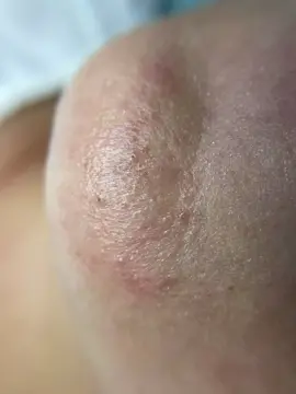 Хочешь своё ДО/ПОСЛЕ? #чисткалицакраснодар #косметологкраснодар