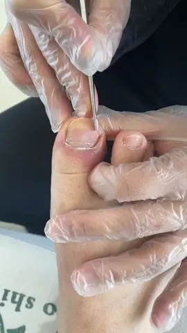 #ingrowntoenail #ingrown #ingrowntoenailremoval #toenail #toenailfungus #ingrowntoenailsurgery #ingrownnail #infectedingrowntoenail