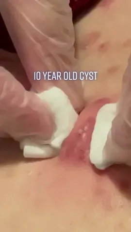 When your sisters 10 year old cyst finally erupts 🙃 #foryou #fyp #pimple #pimplepop #satisfying