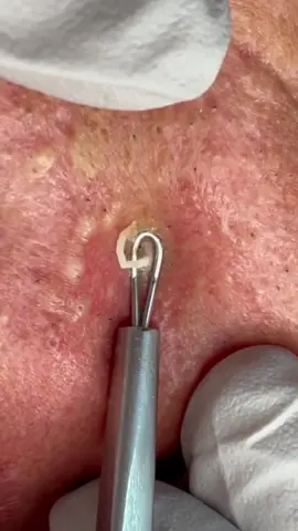 Full face 🌝 extractions #fyp #foryou #blackheads #acne #pimple