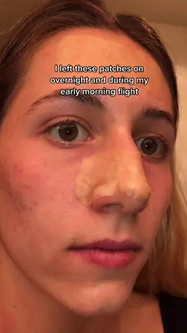 Were the results worth it? #asmr  #airplaneskincare #noseporestrips #pimplepatches #fyp #acne