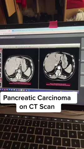 Here you can see what #pancreaticcancer looks like on a #ctscan #pancreas #pancreatitis #cancer #ct #scan #patient #diagnosis #doctok #medicalschool #medschool #medstudenttiktok #medstudent #internationalstudent #internationalmedicaluniversity #zoom #googleclassroom #zoomuniversity #radiology #radio