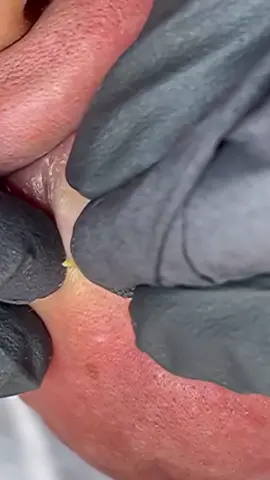 blackheads removal from the lips #fyp #acne #foryou #pimple #blackhead #blackheads
