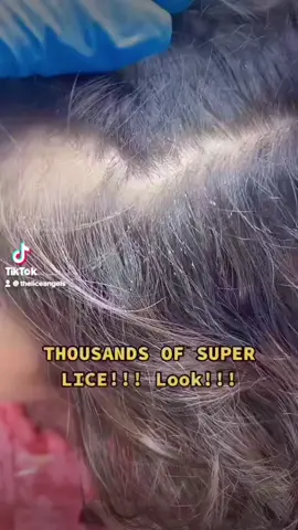 💥baby has lice💥 so many crawlers! Watch before & after #Fyp #Baby #Theliceangels #Lice #Hair #MomsofTikTok #Foryou #Piojos #Kids