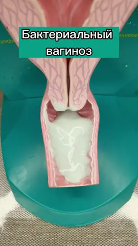 Бактериальный вагиноз #гинекологалимова #бактерии #бактериальныйвагиноз #гинеколог