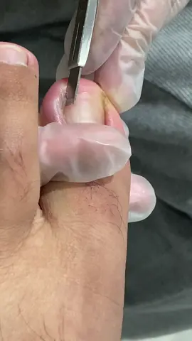 Short advance toes #toe #ingrown