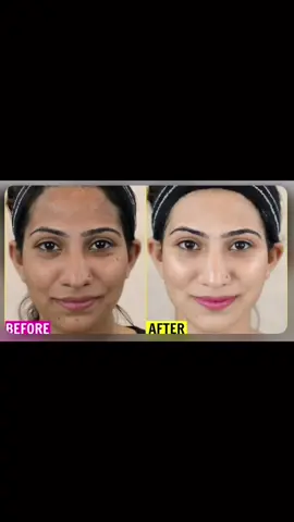 #glutathionedrip #ivdripladies #ivdriptherapy💧 #ivdripclearwater #whiteningskinoriginal #whiteningskin2021 #lightningskin #malasmatreatment #تبييض