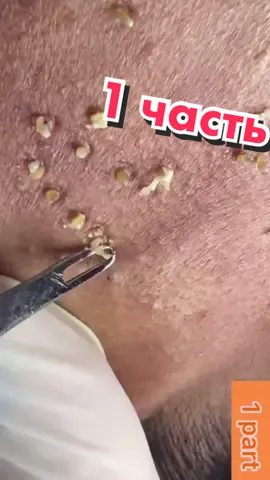 #угри #комедон #чернаяточка #прыщи #гной #акне #акне #атерома #гнойник #гнойныйпрыщ