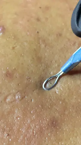 “Yea” 😂😂 extractions are necessary | IG: its.smesthetics #MacysGiftTok #fyp #SpotifyWrapped #AmazonMusicJingleBellTo  #skincare #extractions