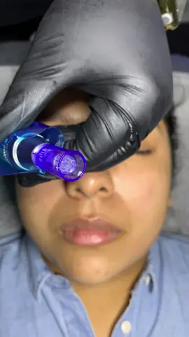 Microneedling has become my top 3 of favorite skincare treatments🥰 | IG: its.smesthetics #JBLGreekOut #MacysGiftTok #fyp #CustomersMostLoved