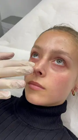 Undereye filler, DM us on Instagram at @drducu for more details #undereyefiller #undereyecircles #undereyetreatment  #plasticsurgery #beforeandafter