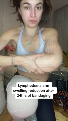 Part 3: Day 1 of 7, #lymphedema arm resuction progress #chronicillness #swelling
