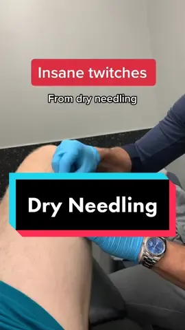 Muscle twitches #physicaltherapy #physiomike #dryneedling #pain #legs #physio #foryou #foryourpage