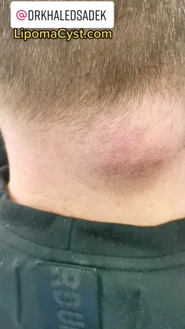 Massive Cyst #pimplepopper #cystremoval #drkhaledsadek @drpimplepopper