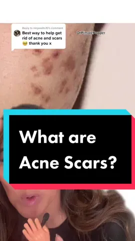 Reply to @ninjaedits10  acne & acne scars I’ll talk about the types of acne scars later! #drpimplepopper #SLMDskincare