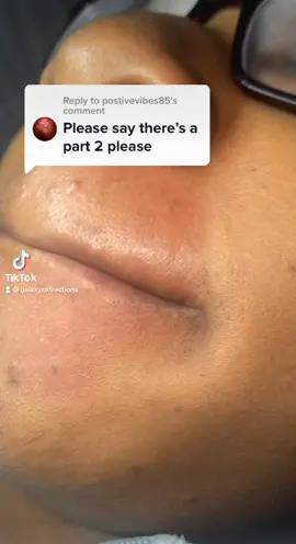 More extractions please #extractions #pimplepopper2021 #waxingvideos #galaxybaddie