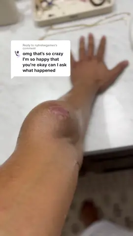 Reply to @nytroloxgames I had bone cancer that was localized in a tumor on my left arm. The tumor grew large, quickly and was pushing against my radial nerve which caused it to be extremely painful. This video is from the night before they cut my arm off. #amputee #staypositive