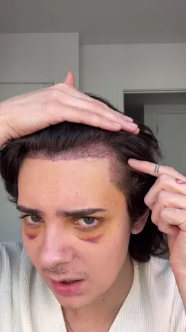 1 week post op!! #hairtransplant #beauty #surgerytok #fut