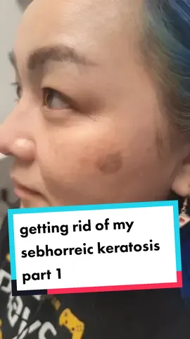 it's not cancerous it just a part of getting old #skincarejourney #skin #over40