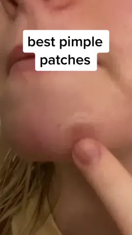 Seriously y’all NEED the micropoint patches for those under the skin pimples #hormonalacne #acnepatches #herocosmetics #acnetips #DisneyPlusVoices