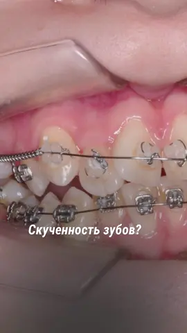 Приглашаем на бесплатную консультацию в инст: drblinder или по ссылке в шапке профиля 💕 #здоровыезубы #брекеты #стоматология