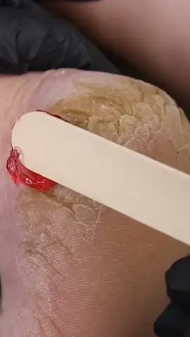 Severe Callused And Cracked Heels Transformation! #LearnOnTikTok #beauty #nails #pedicure #transformation