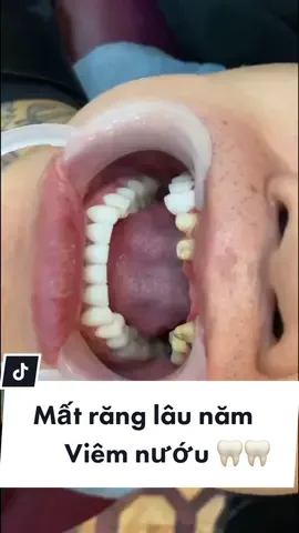 Mất răng lâu năm - viêm nướu ... và sự thay đổi ngoạn mục sau 2 ngày 🦷🦷 #drhan치과전문의 #drhandentist #reviewlamdep #rangsu #dansuverneers #drhan #fyp