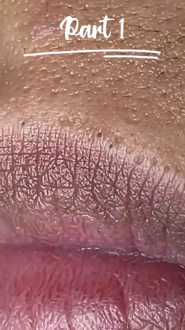 blackheads removal from the lips 💋, #blackheads #satisfying #foryou #pimple #fyp #acne #blackhead