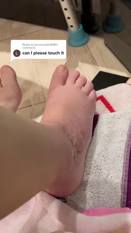 Reply to @laurenrutter806 Can’t touch this! 😂 #brokenankle #surgery #brokenfoot #SelfCare #selfcaretips #beckermantwins #canttouchthis