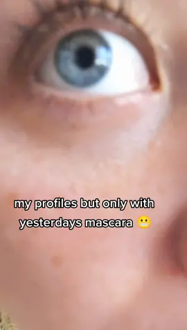 don't look at my #tineaversicolor