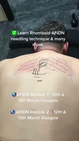 Learn Dry Needling in Glasgow this March #afidn #sportstherapy #sportstherapyscotland #painmanagement #dryneedling #shoulderpain