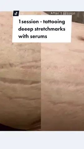 like microneedling, it can FILL IN deep scars/stretchmarks (triggering skin regrowth) #paramedicaltattooing #inklessstretchmarkremoval #tattoos #fyp