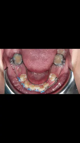 Preservation and management of space in the late mixed dentition 🔑#orthodontist #orthodontics #braces #ortodontia #ortodontista