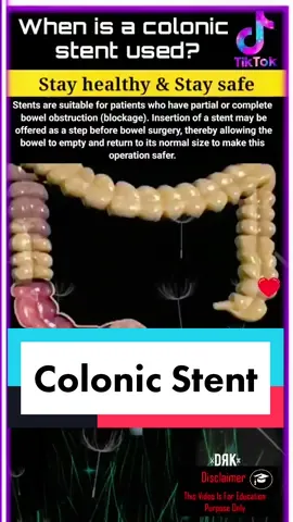 Topic: Colonic Stent #drk #EduTok #LearnOnTikTok #tiktokguru #jombelajar #kongsiraya #stent #bowel #colonic #colonicstent #medical