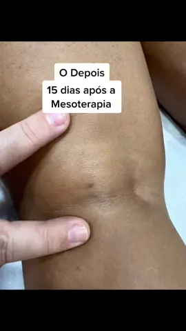 #natura_aesthetic_clinic #natura_day_spa_oficial #fy #foryou #publicidade #mesoterapia #estrias