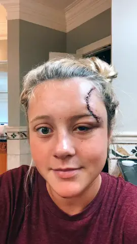 Scar gone after two years 😁😁