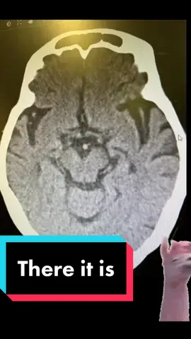 Tell me someone else sees this? #ctscan #brain #neurological #scan #xray