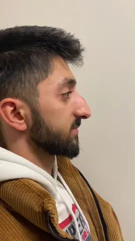 🔥🔥🔥#nosejobcheck #revisionrinoplasty