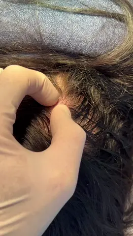Atheroma of the scalp. more videos without limits link in profile