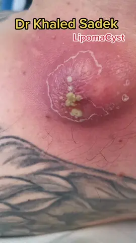#cystremoval #pimplepopper #blackheads #drkhaledsadek Dr Khaled Sadek Lipomacyst.com