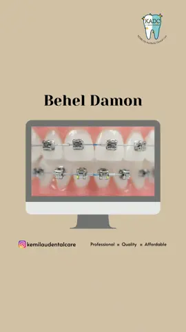 Behel Damon merupakan behel yang menggunakan teknologi terbaru dan tercanggih, dengan perawatan yang lebih cepat, minim rasa sakit dan kontrol lebih jarang dibandingkan behel konvensional #doktergigicirebon #behelgigi #beheldamon #ciayumajakuning
