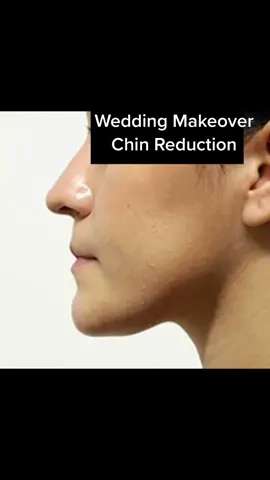 #weddingmakeover #chinreduction #genioplasty 773559777
